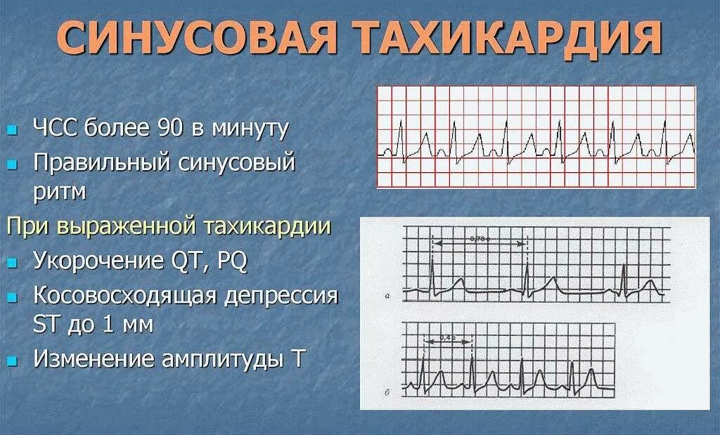 Частый пульс симптомы