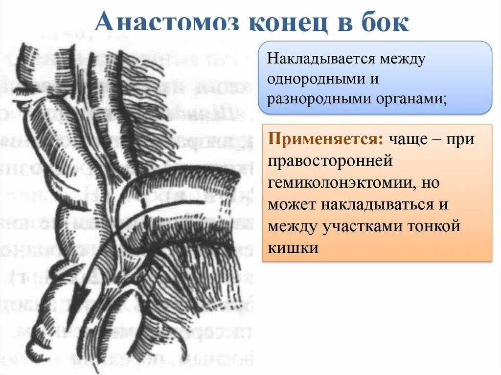 Резекция тонкой кишки анастомозы техника. Желудочно тонкокишечный анастомоз. Межкишечный анастомоз. Кишечный анастомоз конец в бок. Анастомозит что это