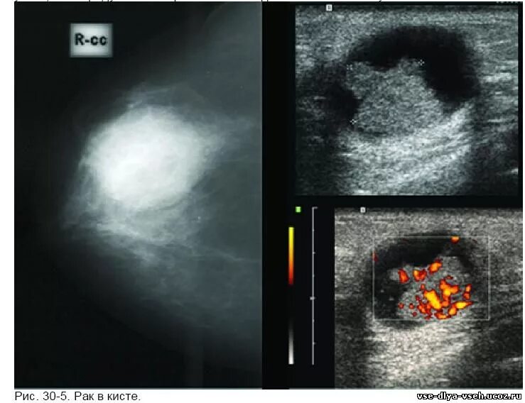 узи молочных желез уплотнение. узи молочных желез уплотнение. кистозная мастопатия узи. интрамаммарный лимфатический узел узи. ультразвуковое исследование (узи) молочных желез.