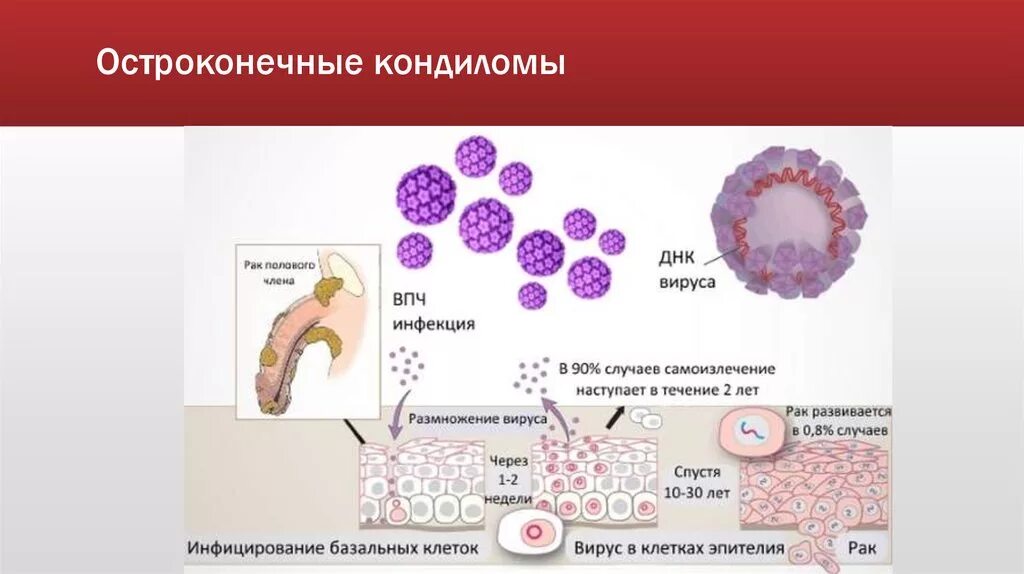 Папиломы вирус передается от человека к человеку. Остроконечные кондиломы НПО. Папилломавирусная инфекция 66 Тип.