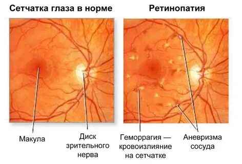 Ретинопатия глаза симптомы