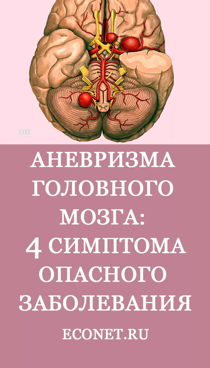 Аневризма головного мозга. Аневризм головного мозга. Аневризма артерии головного мозга. Аневризма мозга симптомы.