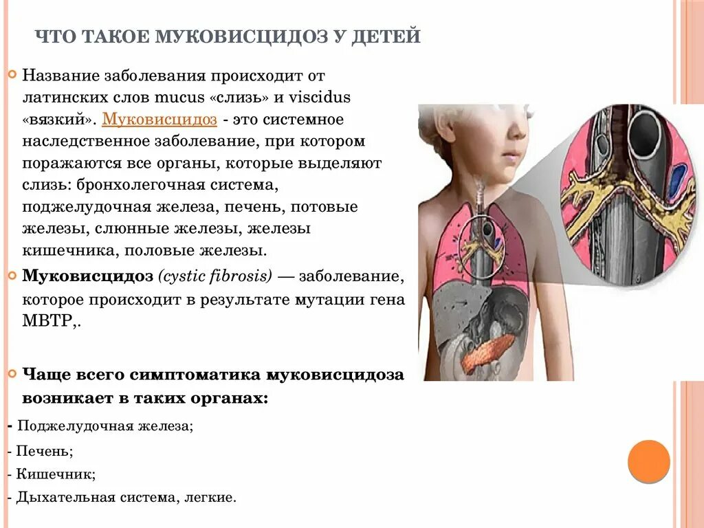 Профилактика при муковисцидозе. Муковисцидоз инвалидность. Муковисцидоз инвалидность. Муковисцидоз инвалидность. Муковисцидоз инвалидность.