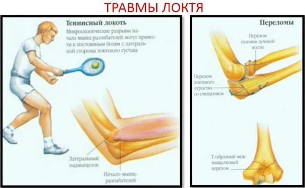 Сгибание и разгибание в локтевом суставе. Перерастяжение связок локтевого сустава. Травма локтевого сустава. Повреждение локтевого сустава.