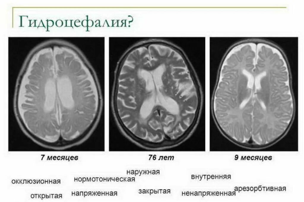 Заместительная наружная гидроцефалия кт. Гидроцефалия головного мозга на кт. Наружная гидроцефалия головного мозга мрт.