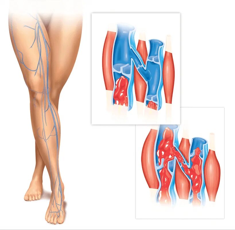 Тромб подколенной вены. Варикоз расширение вен нижних конечностей. Варикозное расширение вен голени. Варикозное расширение вен нижних конечностей, тромбофлебит. Тромбоз бпв
