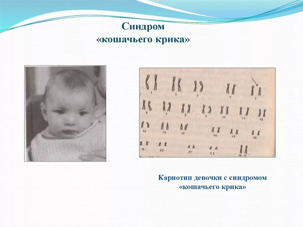 Что такое синдром крика. Синдром «кошачьего крика» (делеция короткого плеча 5-й хромосомы). кариотип больного с синдромом кошачьего крика. хромосомные заболевания синдром кошачьего крика. кариотип больного с синдромом кошачьего крика формула.
