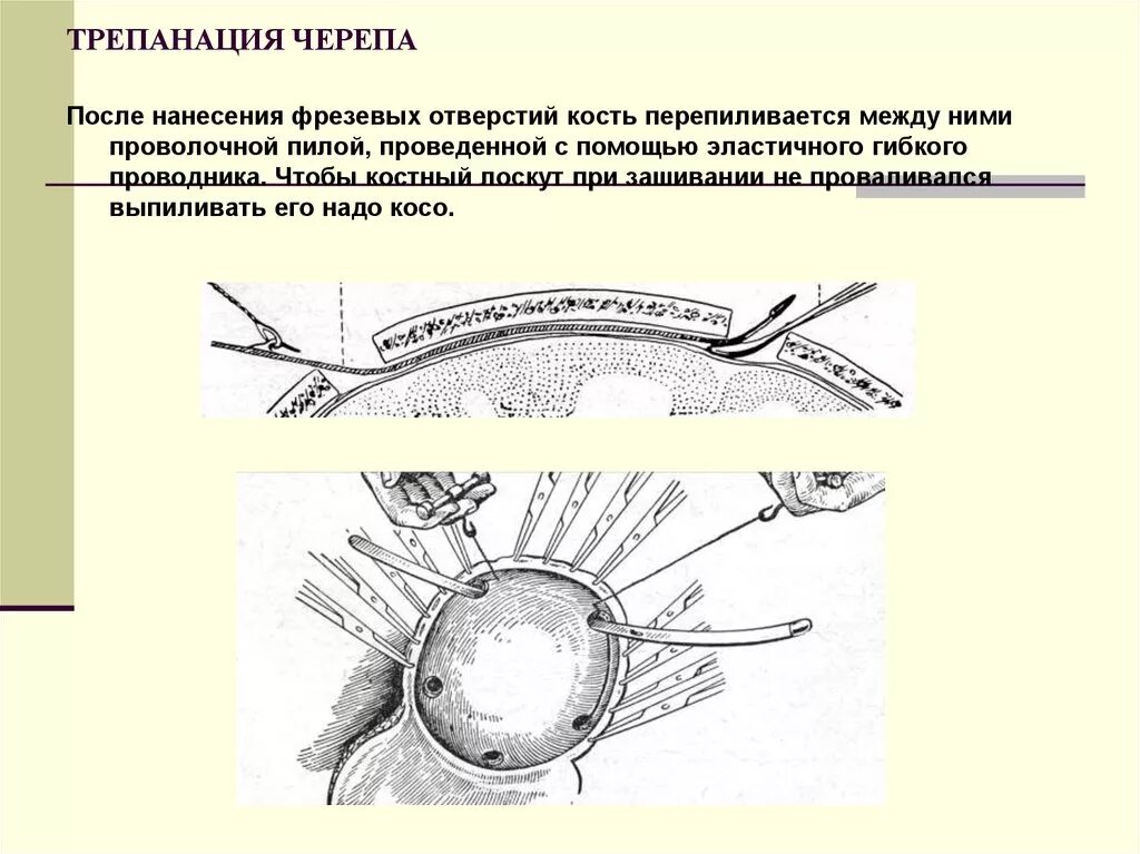 Костно-пластическая Трепанация. Костно-пластическая Трепанация черепа ход операции. Декомпрессионная (резекционная) Трепанация черепа. Принципы резекционной трепанации черепа.