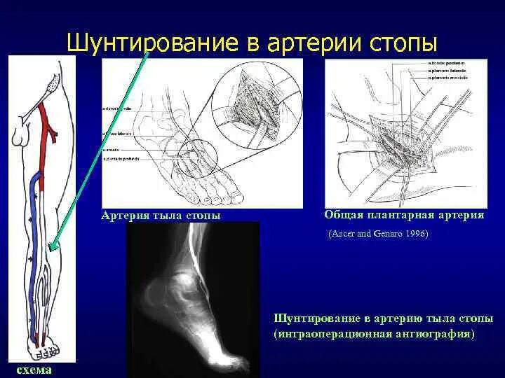 Шунтирование артерий нижних конечностей. Аутовенозное шунтирование нижних конечностей. Шунтирование артерий стопы. Операция шунтирование артерий нижних конечностей.