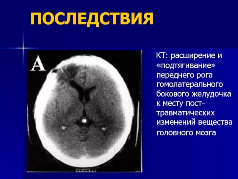 Расширение боковых рогов