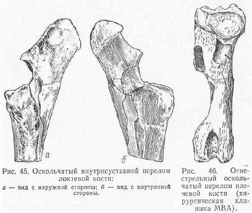 перелом плоских костей. переломы плоских костей. переломы костей классификация травматология. переломы костей черепа классификация. линейный перелом костей свода черепа.