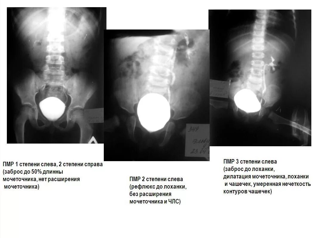 Пузырно-мочеточниковый рефлюкс (ПМР). Пузырно мочеточниковый рефлюкс цистография. Пузырно-мочеточниковый рефлюкс микционная цистография. Пузырно-мочеточниковый рефлюкс цистоуретрография. Рефлюкс мочеточника
