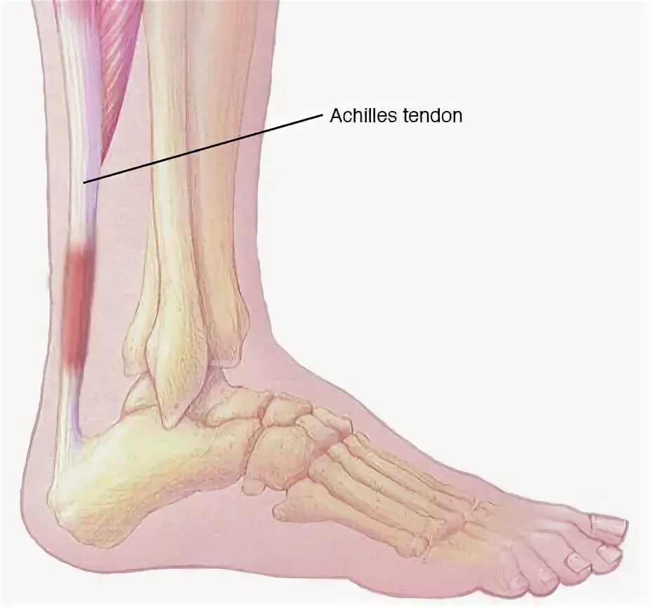 как лечить ахиллово сухожилие