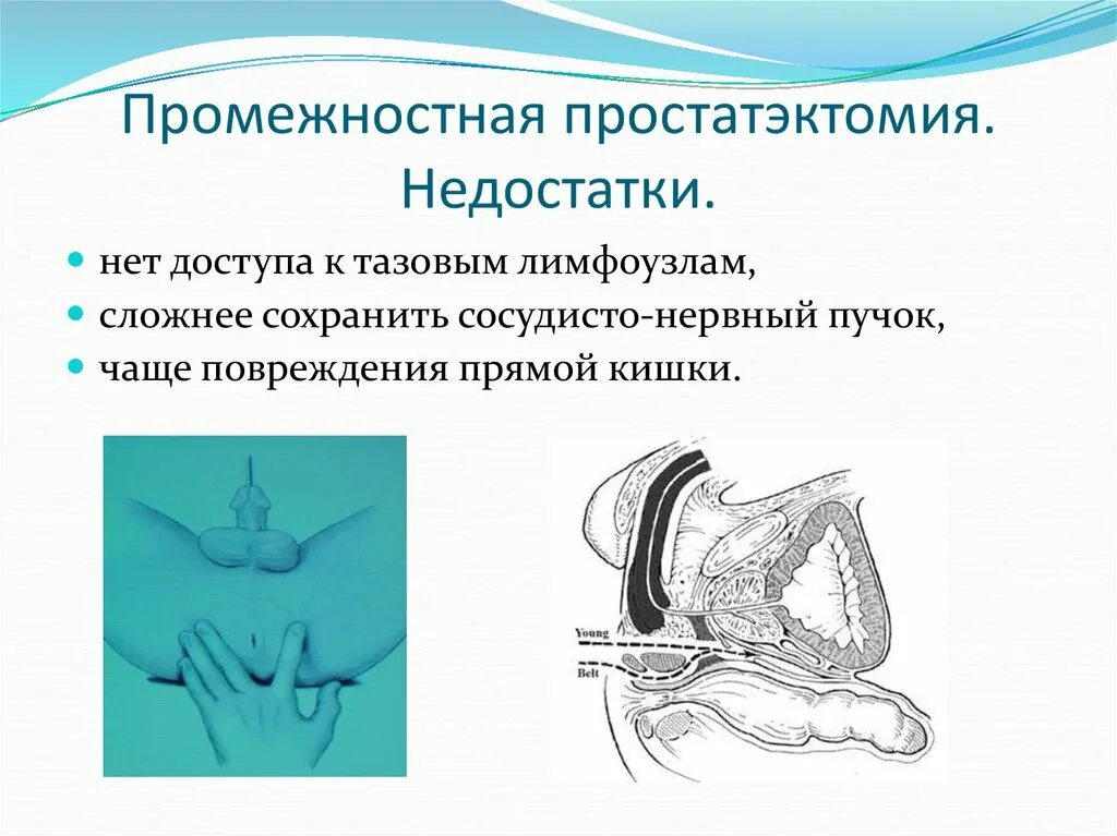 Простатэктомия простаты. Промежностная простатэктомия. Радикальная позадилонная простатэктомия. Радикальная простатэктомия операция. Простатэктомия ход операции.