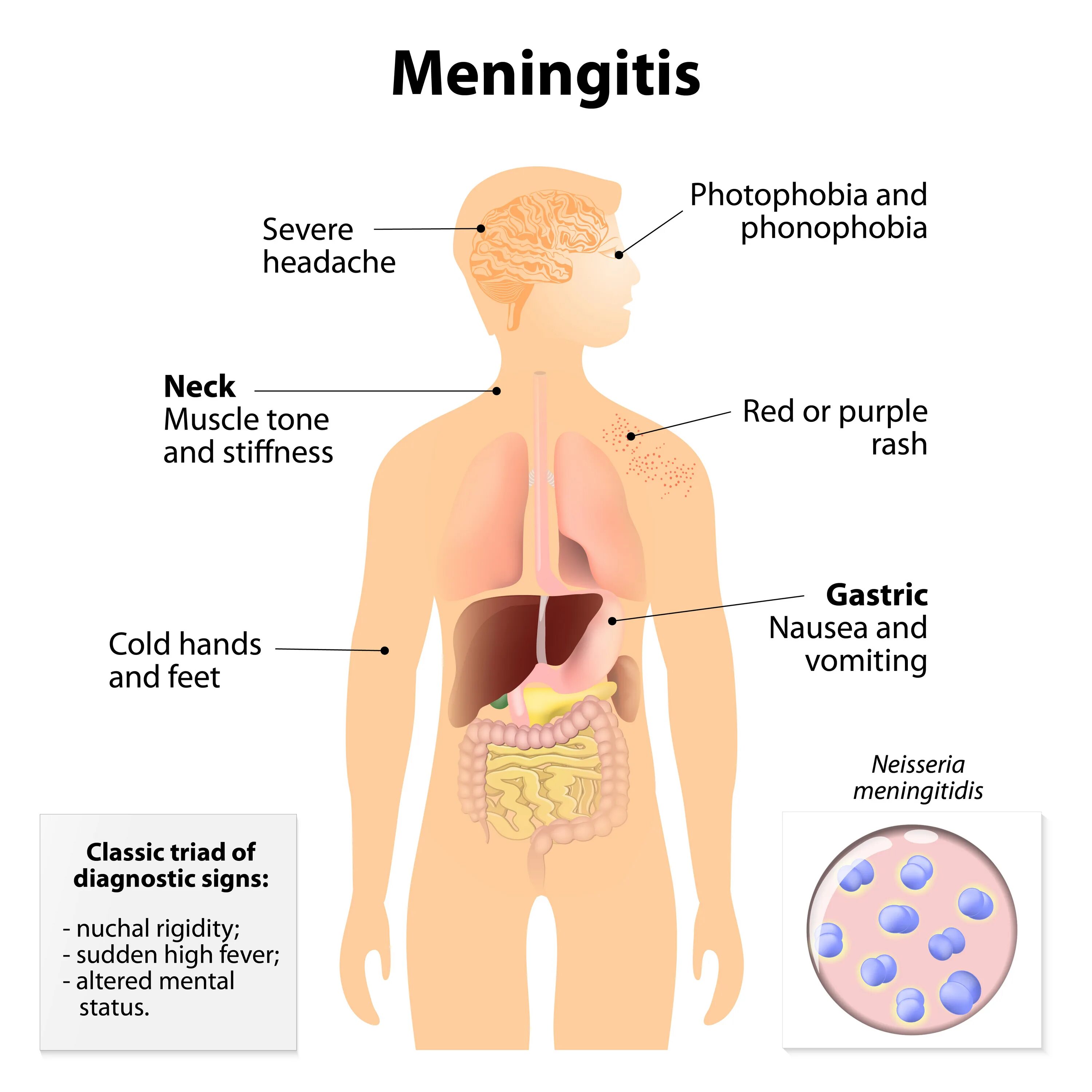 Meningitis Symptoms. Sepsis Symptoms. Фонофобия это