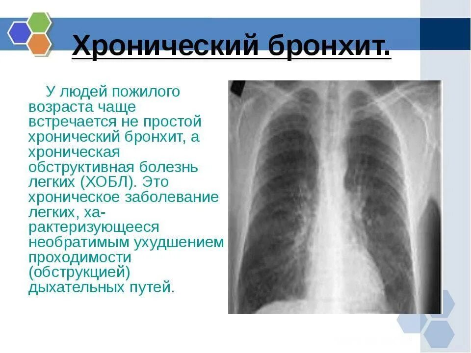 Хроническое воспаление бронхов. Ренгенпризнаки хронического бронхита. Трахеобронхит лечение кашля