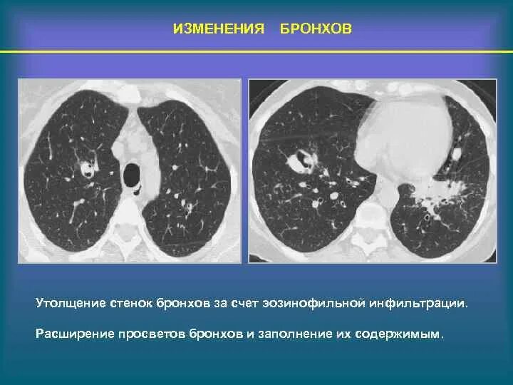 Утолщение бронха. Утолщение стенок бронхов на кт. стенки бронхов уплотнены. утолщение стенок бронхов. расширение просветов бронхов.