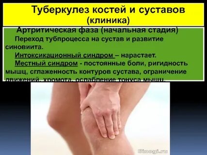 Туберкулез костно суставной системы