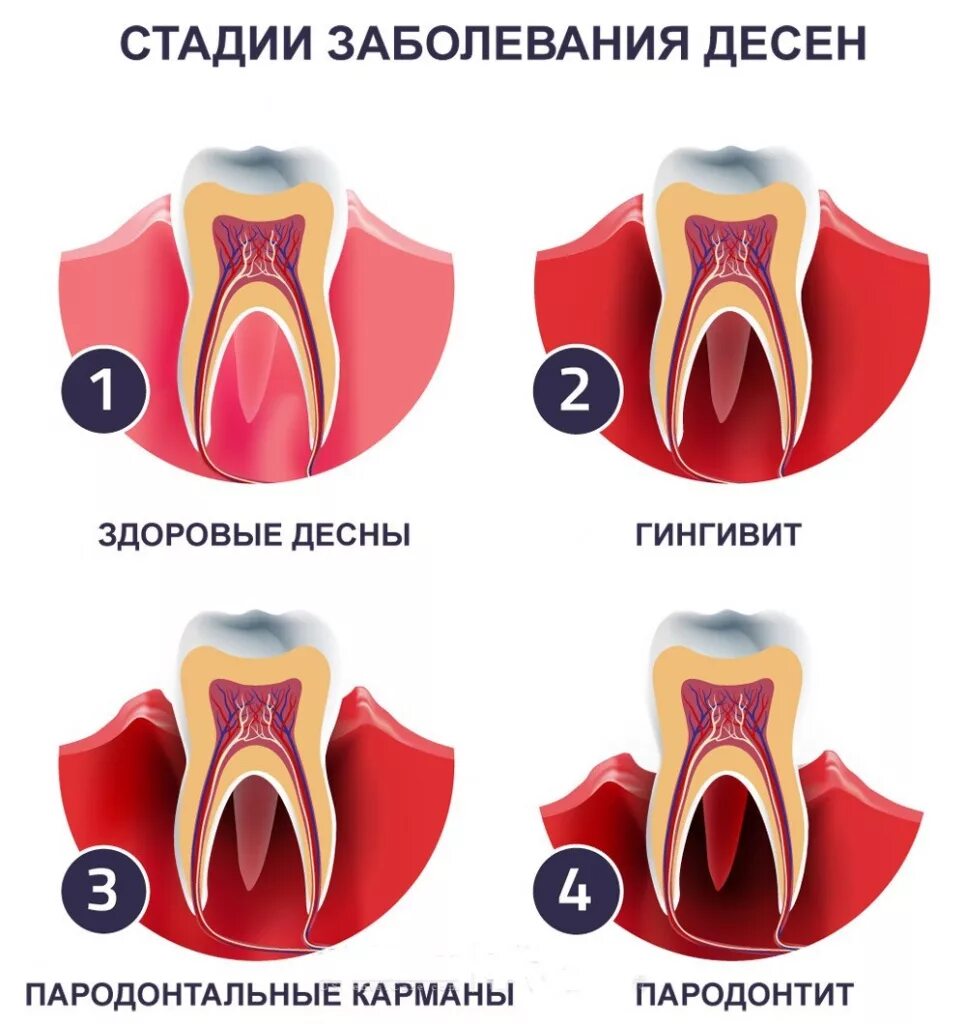 Почему кровь из зубов. Воспаление и кровоточивость десен.