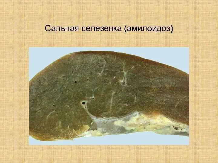 Саговый амилоидоз селезенки. Амилоидоз селезенки макропрепарат. саговая селезенка макропрепарат. саговая селезенка гистология.