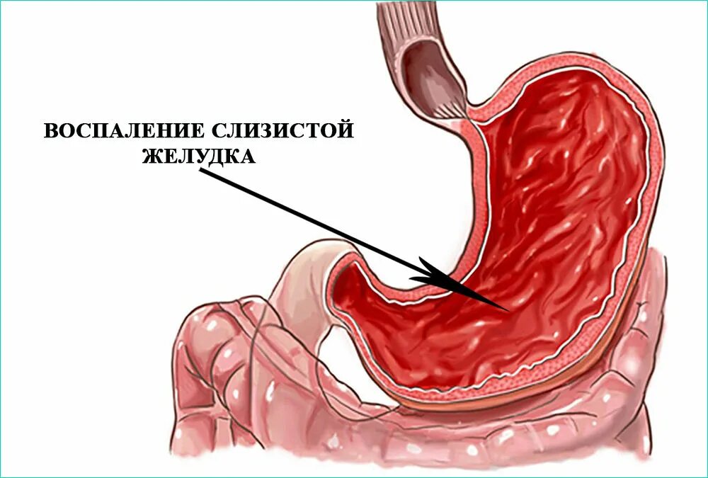 Гастрит слизистой оболочки желудка воспаление. Диффузный поверхностный гастрит. Воспалительные заболевания слизистой оболочки желудка. Воспаленная слизистая оболочка желудка.