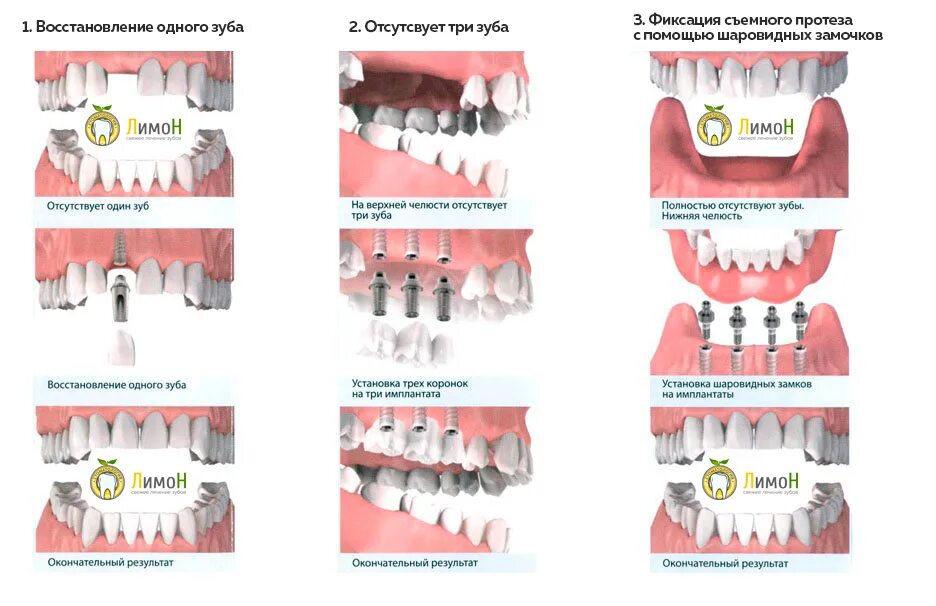 Через сколько можно вставлять зубы. Протезирование зубов схема. Способы протезирования зубов. Имплантация и протезирование зубов.