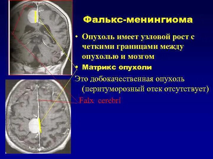 Петрифицированная менингиома. Микрокистозная менингиома. Менингиома серповидного отростка.