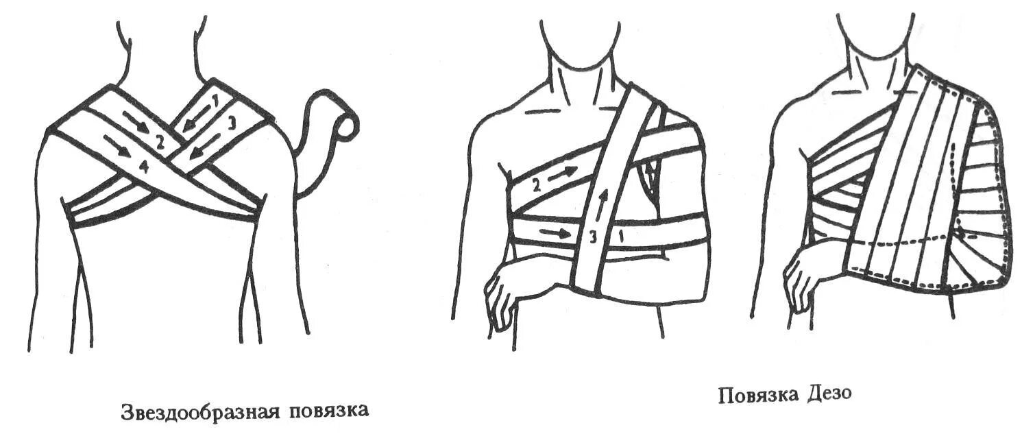 Перевязка шеи. Перевязка Дезо. Крестообразная повязка на локтевой сустав. Десмургия Дезо. Дезо алгоритм наложения.