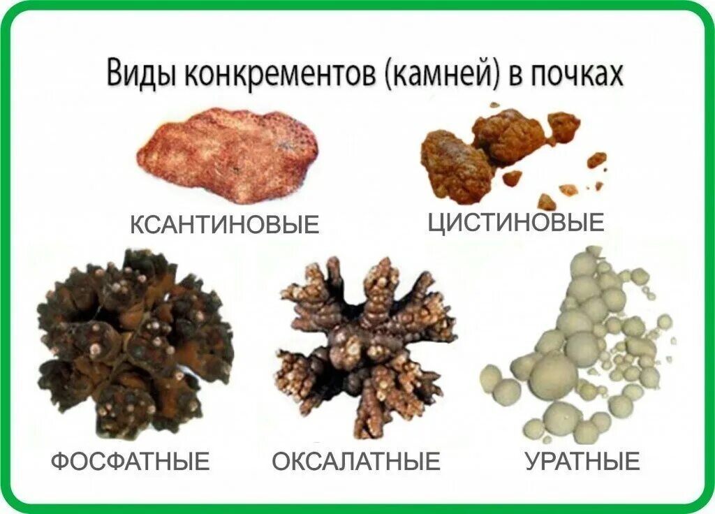 Камень больно. Классификация камней при мочекаменной болезни. Мочекаменная болезнь Ураты оксалаты. Уратные камни при мочекаменной болезни. Ураты фосфаты оксалаты мочекаменная болезнь.