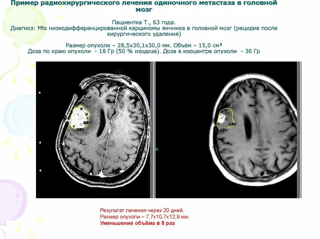 Рецидивы после лучевой терапии. Рецидив опухоли головного мозга. Диагноз MTS расшифровка.