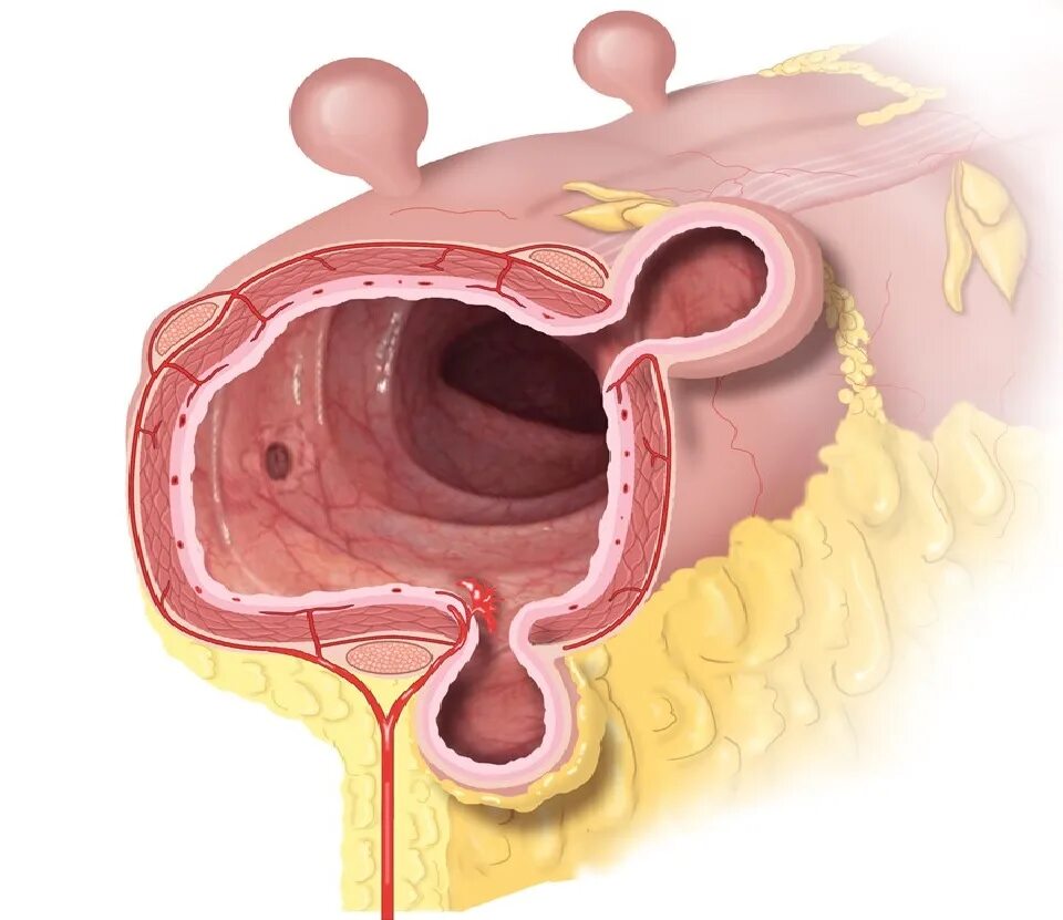 Лечение дивертикулярной болезни кишки. Дивертикулёз-дивертикулит. Дивертикулярная болезнь и дивертикулит. Дивертикулит кишечника. Парафатериальный дивертикул.