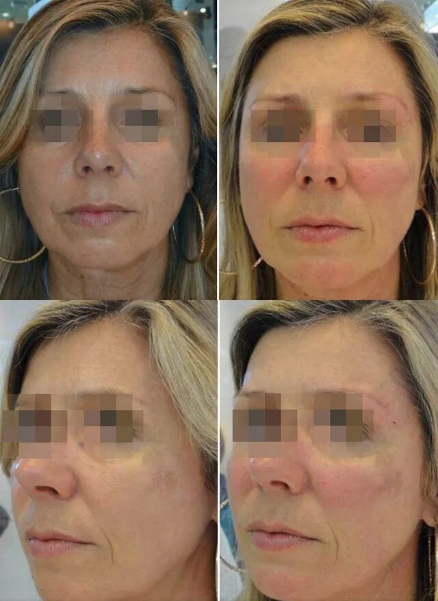 Эльдермафил отзывы эффект фото до и после Btx eyes lift найдено 89 фото