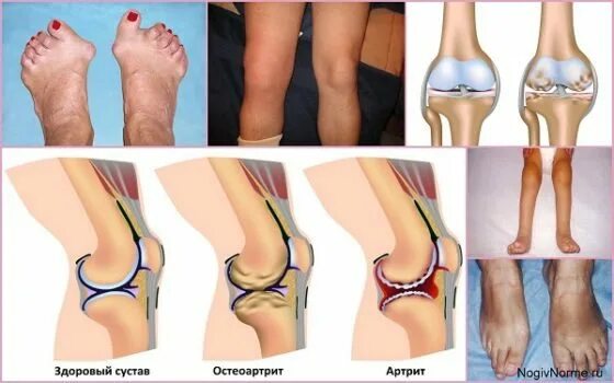 моноартрит коленного сустава. клиническая классификация ревматоидного артрита. артрит виды. ревматоидный артрит ласта морда. ревматоидный артрит деформация кисти.