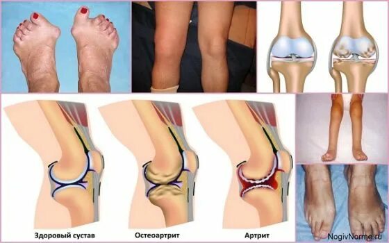 Суставная форма ревматоидного артрита. Запущенный ревматоидный артрит. Виды артритов коленного сустава. Типы артритов