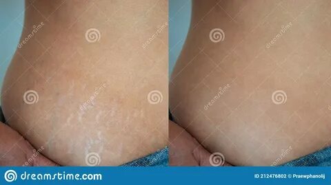 Before And After Treatment Imperfect Skin Problem Stretch Marks On Woman Bo...