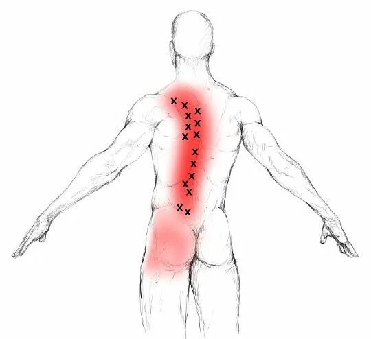 Триггерные точки поясницы. Триггерные точки на спине. Триггерные точки на спине грудной отдел. Триггерная точка поясницы. Триггерные точки атлас.