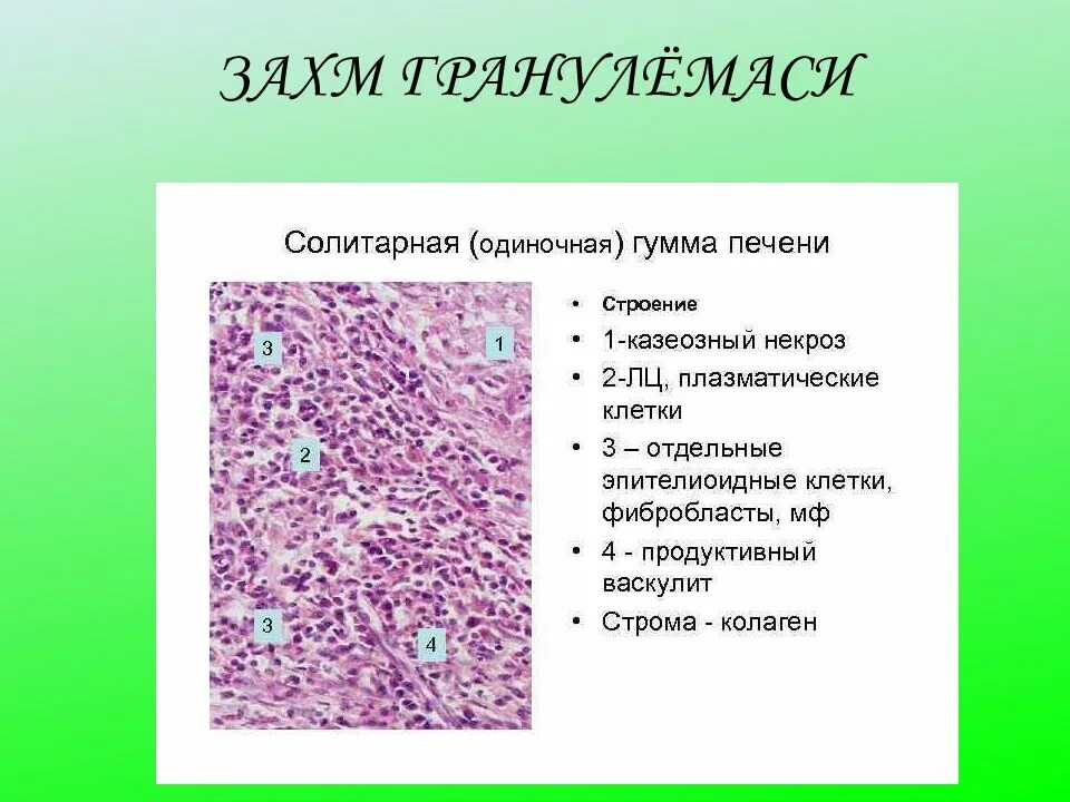 Печень микропрепарат описание. Сифилитическая Гумма печени микропрепарат. Солитарная Гумма печени. Микропрепарат «солитарная Гумма печени». Окраска г-э. Сифилис печени микропрепарат.