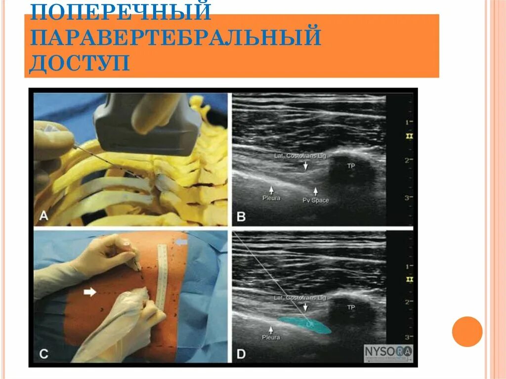 Блокада под узи. Паравертебральная блокада УЗИ. Ультразвук визуализация. Паравертебральный блок под УЗИ. Паравертебральные блокады под контролем УЗИ.