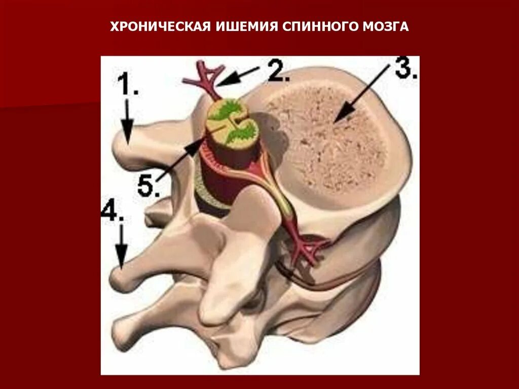 Ишемия нерва. Ишемия позвоночника. Инсульт спинного мозга. Хроническая ишемия спинного мозга.