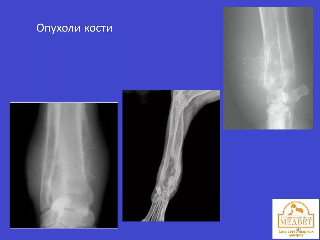 Рак в костях прогноз. Опухоль кости презентация. Опухоли костей и суставов.