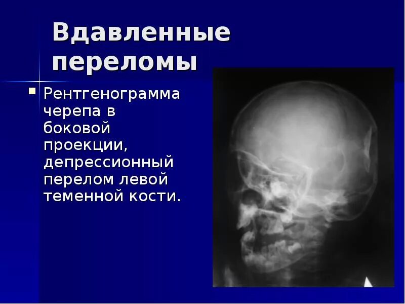 Оскольчатый перелом черепа. Перелом свода черепа рентген.