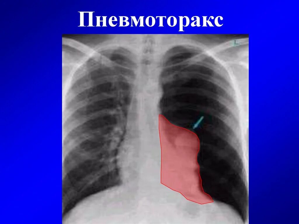 Признаки воздуха в легких. Левосторонний пневмоторакс рентген. Спонтанный пневмоторакс рентген. Правосторонний пневмоторакс рентген. Рентгенография грудной клетки пневмоторакс.