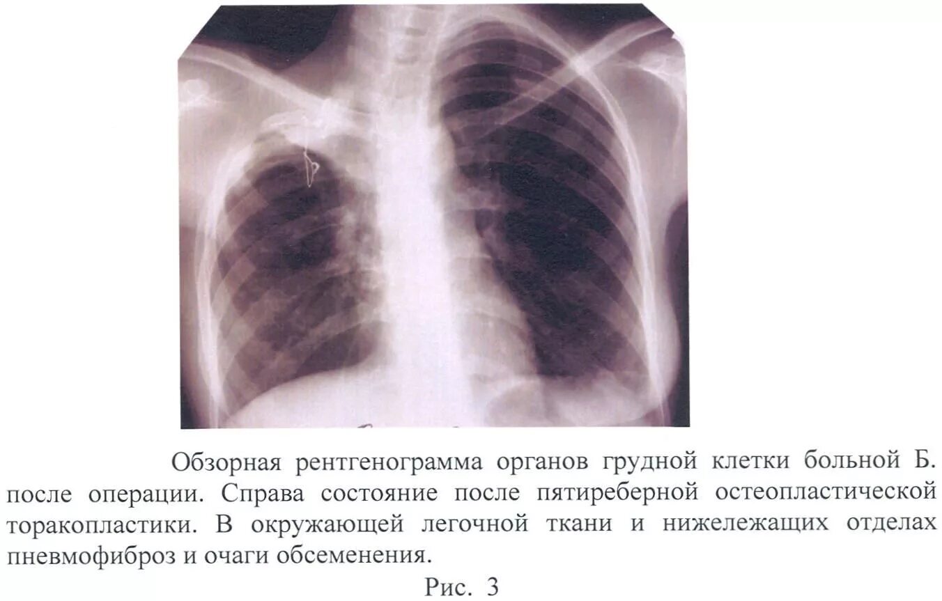 Торакопластика при туберкулезе легких. Операция при туберкулезе легких. Обзорная рентгенограмма органов грудной клетки. Операция на лёгких при туберкулёзе.