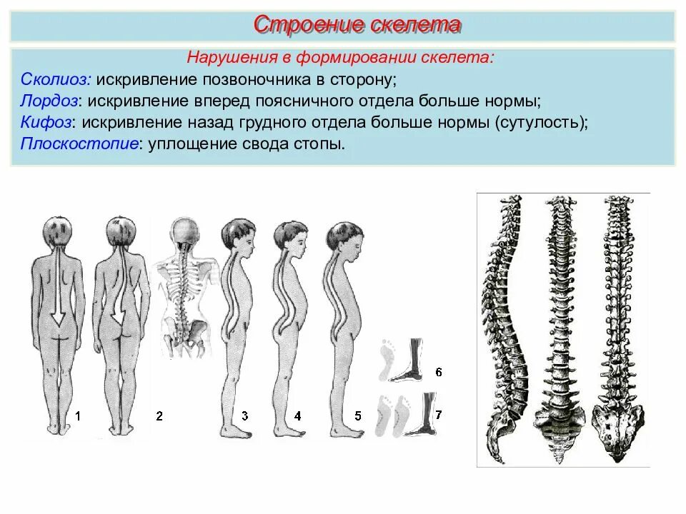 Изменение формы позвоночника. Искривление позвоночника кифоз градусы. Искривление позвоночника сколиоз и лордоз. Искривление позвоночника кифоз и лордоз. Конфигурация позвоночника в норме.