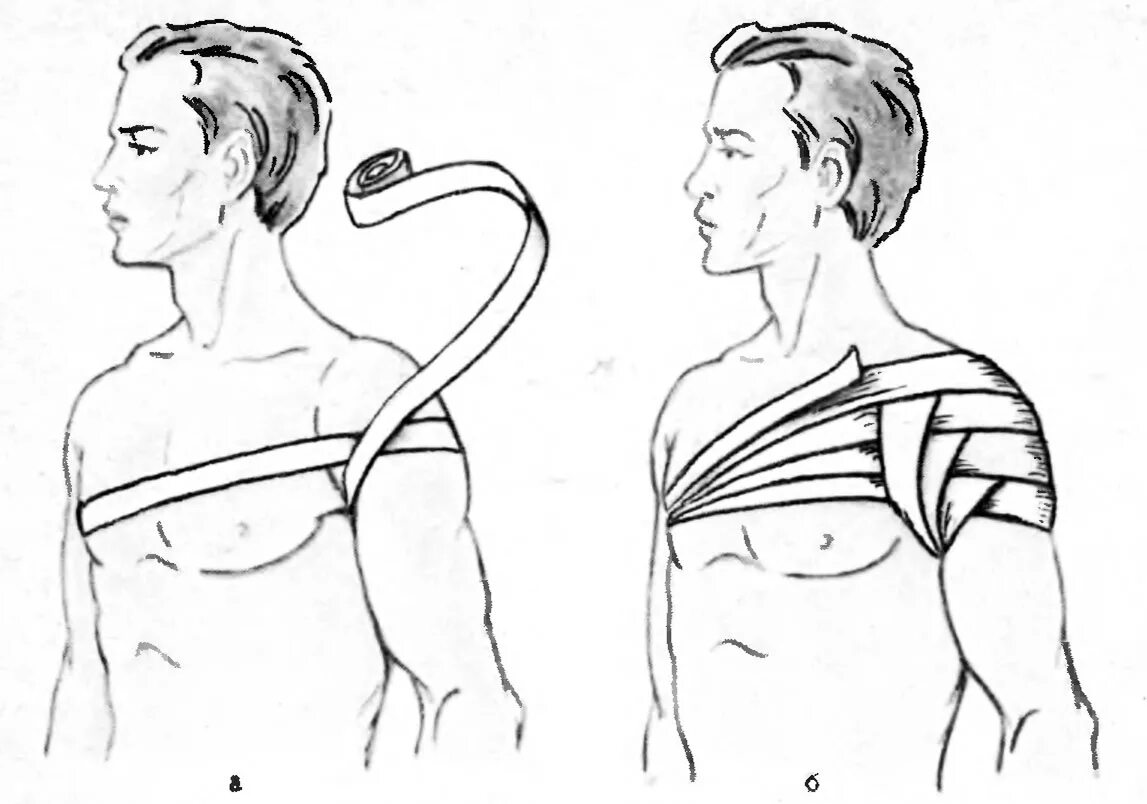 Вывих плеча повязка колосовидная. Вывих плеча Косыночная повязка. Повязка при вывихе плечевого сустава. Вывих плечевого сустава перевязка. Через какое плечо нужно