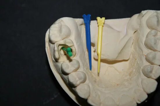 Оттиск для вкладки. Моделирование культевой штифтовой вкладки непрямым методом. Снятие оттиска для вкладки. Моделировка культевой штифтовой вкладки. Одноэтапный двухфазный оттиск оттиск.