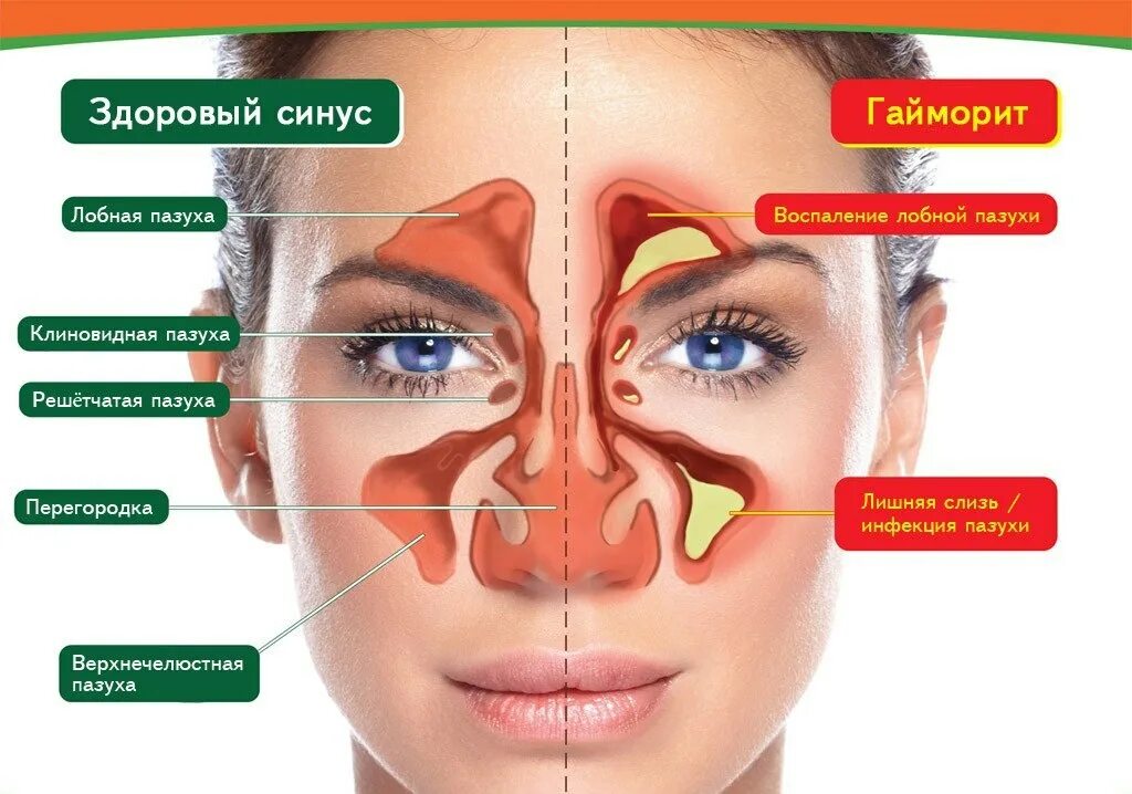 Острая головная боль температура заложенность носа. Строение гайморовых пазух. Строение носа и гайморовых пазух. Носовые пазухи, переносица строение.