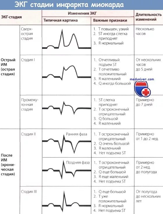 St ишемия. ЭКГ признаки острой стадии инфаркта миокарда. Острейший период инфаркта миокарда на ЭКГ. Периоды инфаркта миокарда на ЭКГ. ЭКГ критерии острой стадии инфаркта миокарда.