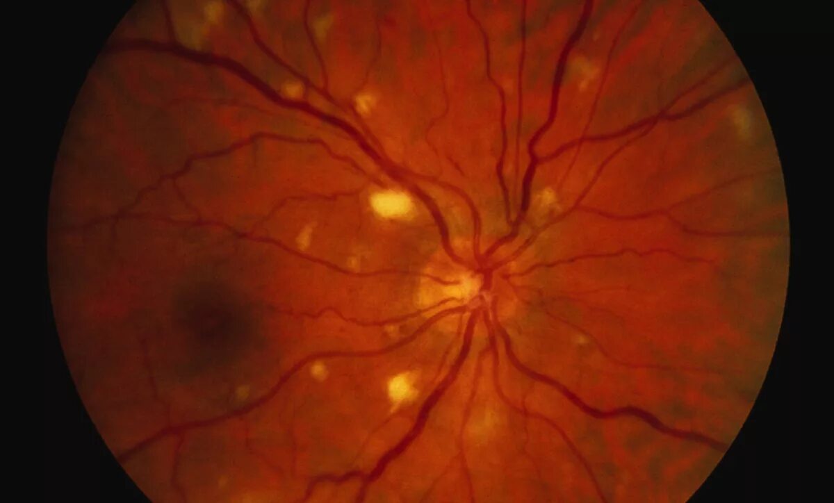 Диффузные сосуды. Ретинопатия хориоретинит. Сифилитический ретинит. Сифилитический хориоретинит. Цитомегаловирус ретинит.