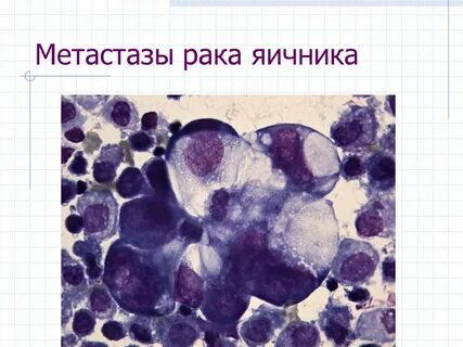 Рак яичников метастазы